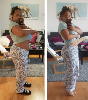 antes y después tratamiento obesidad