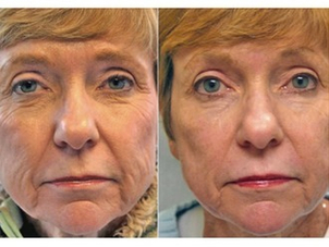 antes y después peeling