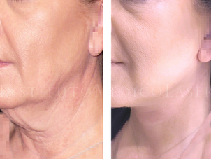 antes y después lifting