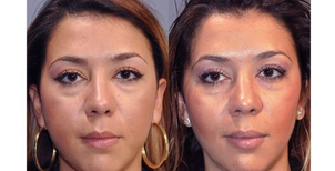 Antes y después de una bichectomía