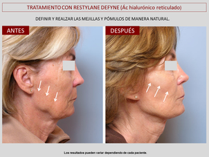 lifting sin cirugía