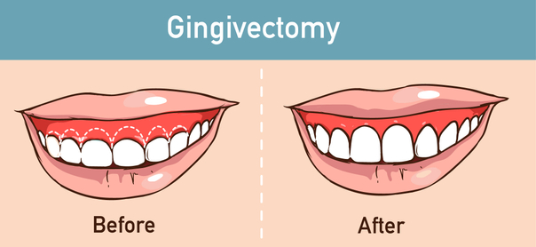 Gingivectomía