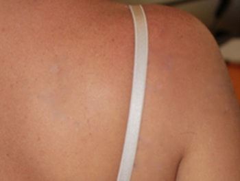 Eliminación de tatuajes