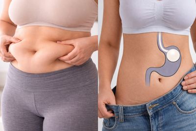 Antes y después de Balón gástrico