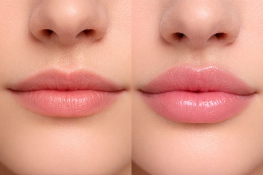 Aumento labios