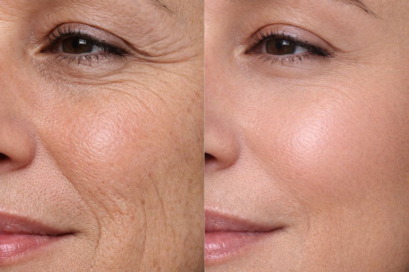 Radiofrecuencia facial