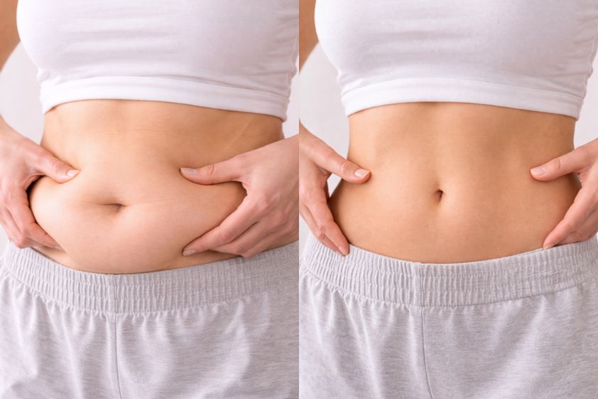 Tratamiento obesidad