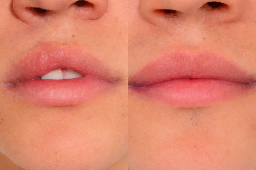 Queiloplastia