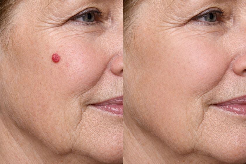 Angiomas