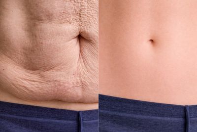 Antes y después de Abdominoplastia