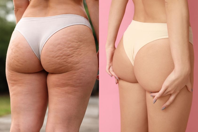 EMSculpt®
