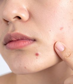 Tratamiento antiacné