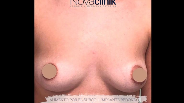 Aumento de pecho - NovaClínik