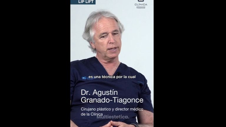 Lip lift - Clínica Granado Tiagonce