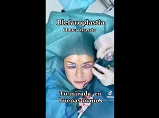 Blefaroplastia - Marista Clínica