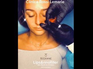 Rinomodelación + Aumento de labios - Clínica Rossi Lemarie