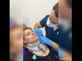 Aumento de labios - DERMATOdesign