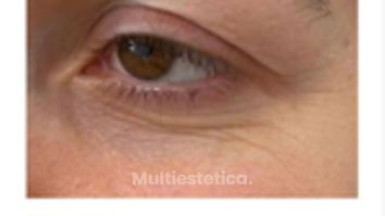 Blefaroplastia laser REJUVENECIMIENTO DE LA MIRADA