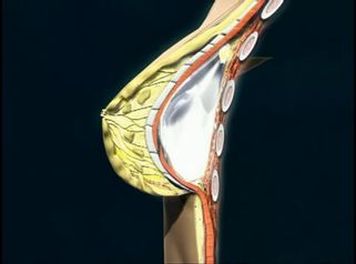 ¿Cómo se introducen las prótesis mamarias?