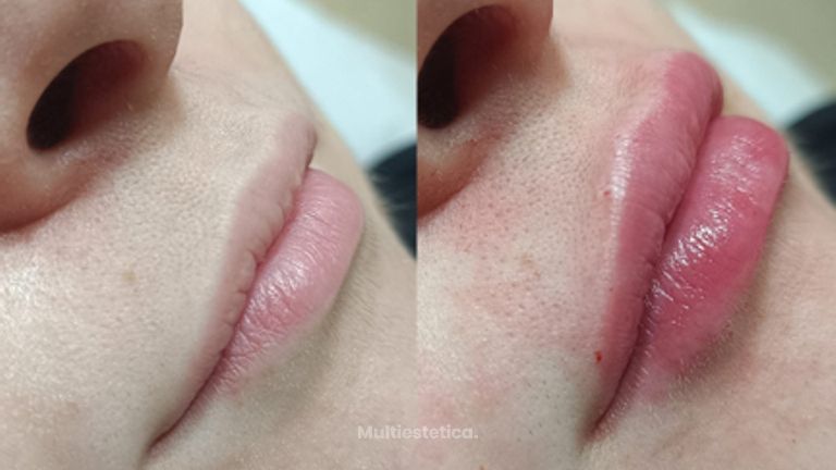 Armonización labios