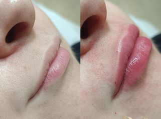 Armonización labios