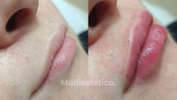 Armonización labios