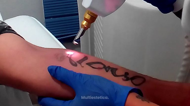ELIMINACIÓN DE TATUAJES