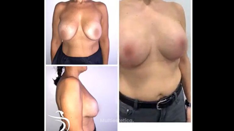 Mastopexia - Dr. Sergio Morral