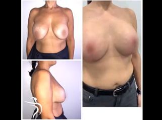 Mastopexia - Dr. Sergio Morral