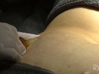 Carboxiterapia para combatir las estrías y la celulitis
