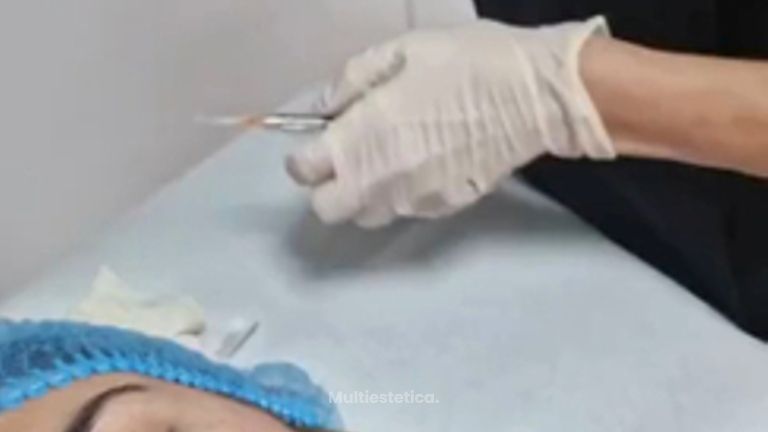 Clínica Montecarmelo - Eliminación Ojeras