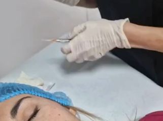 Clínica Montecarmelo - Eliminación Ojeras