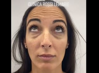 Toxina botulínica - Clínica Rossi Lemarie