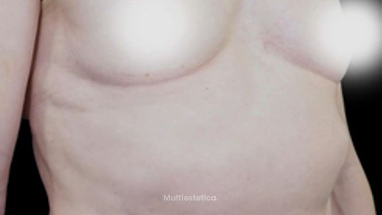 Antes y después del Aumento mamario de una paciente con 300cc