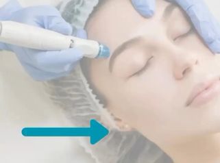 Limpieza HydraFacial - Grupo Médico Clínicas Massana