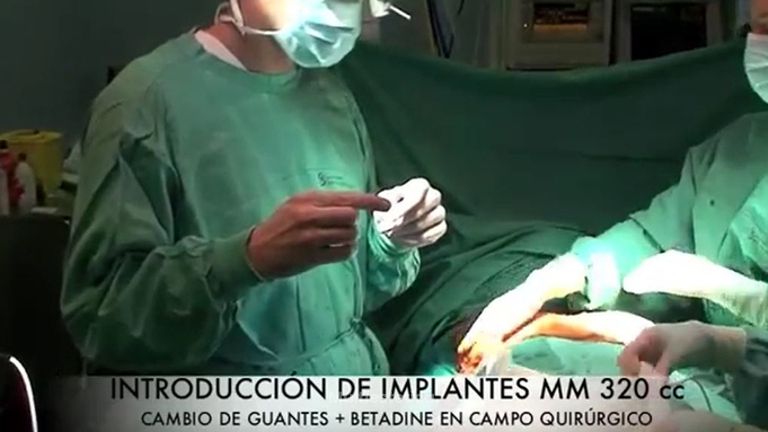 Mastopexia periareolar con prótesis (aumento) - Dr. Guilarte