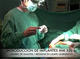 Mastopexia periareolar con prótesis (aumento) - Dr. Guilarte