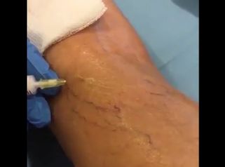 Tratamiento de varices