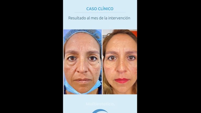 Blefaroplastia - Dr. Jiménez Ortiz