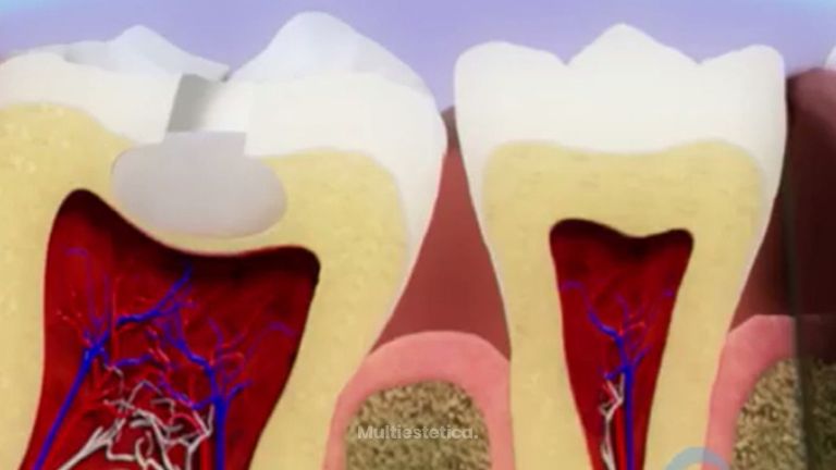 La mejor forma de tratar una inflamación de la pulpa dental