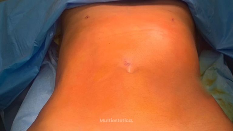 Abdominoplastia 