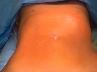 Abdominoplastia 