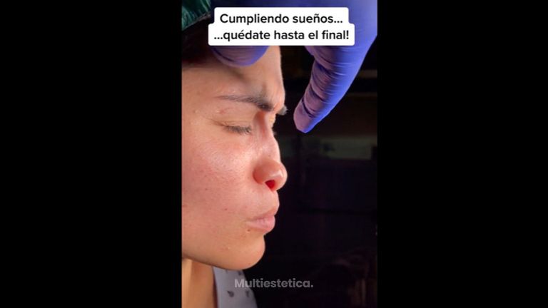 Rinoplastia - Dr. Alberto Candau