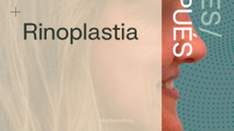 Antes y Después de Rinoplastia