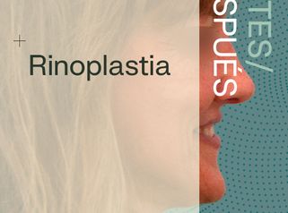 Antes y Después de Rinoplastia