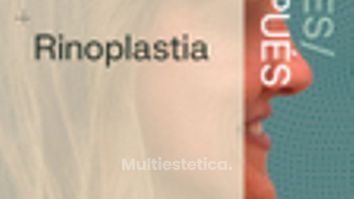 Antes y Después de Rinoplastia