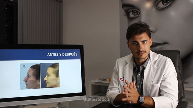 Rinoplastia - Doctor Pérez-Cerezal