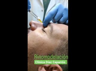Rinomodelación - Clínica Díaz Caparrós