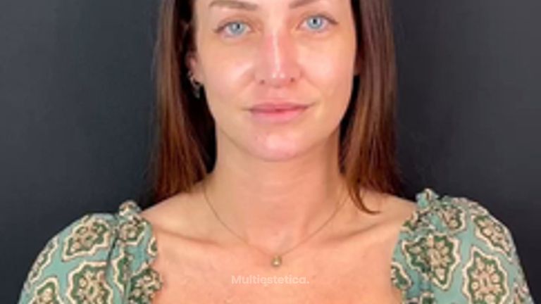 Rinoplastia - Clinica Silvia Roson