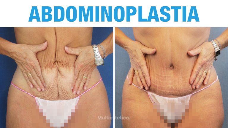 Abdominoplastia después del embarazo – Isabel